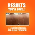 Papaya Beauty Soap before and after skin improvement results