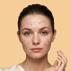 youth face cream for Pimple & Acne